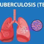 Unpad terlibat uji klinik kandidat vaksin TBC di tengah tingginya kasus di Indonesia